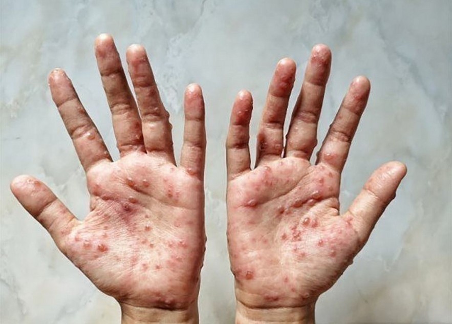 Health Ministry Issues Monkeypox Monitoring Guidance