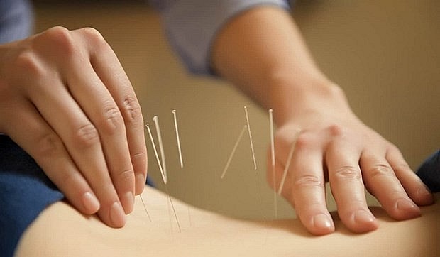 Acupuncture is one of traditional healing methods. Photo: VNA
