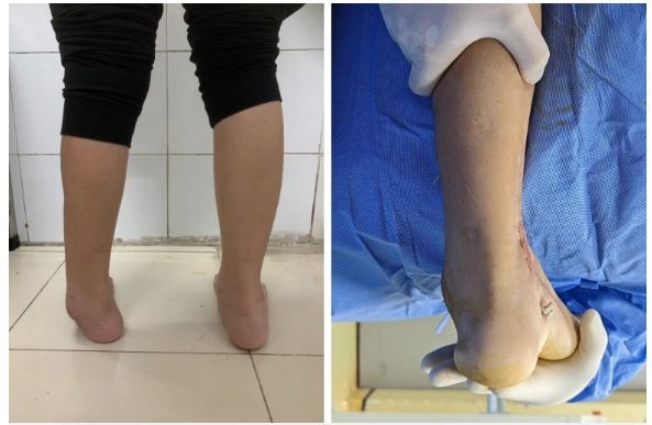 L.H.D patient's leg before and after surgery. Source: Saint Paul General Hospital