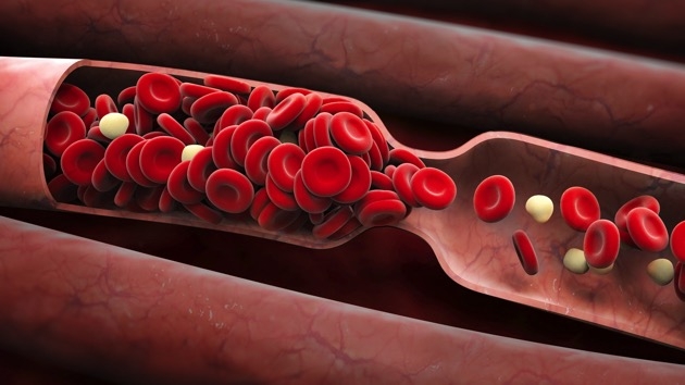 blood clot new deadly complication of covid 19