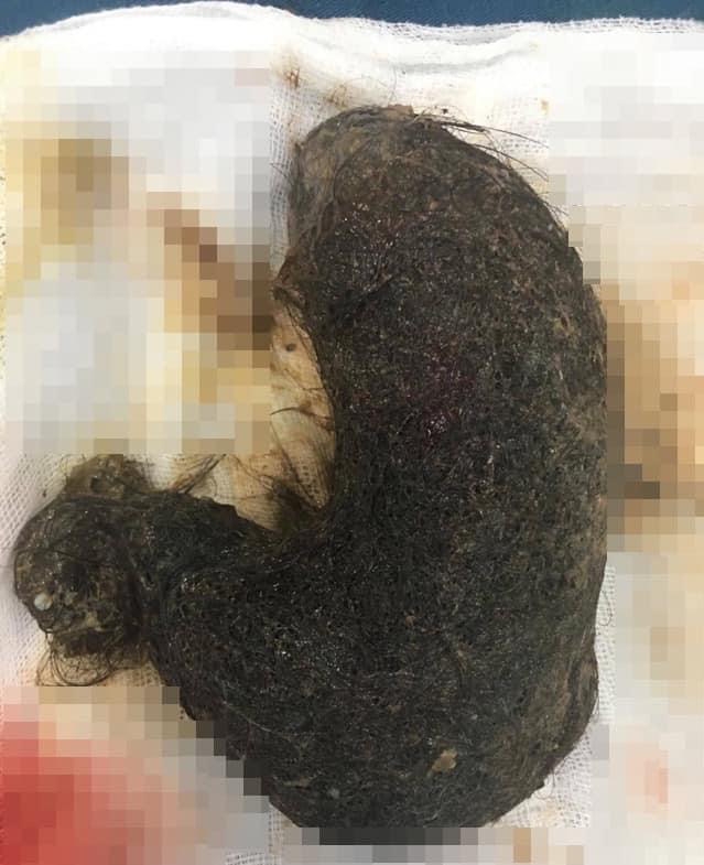 huge hairball removed from 11 year olds stomach