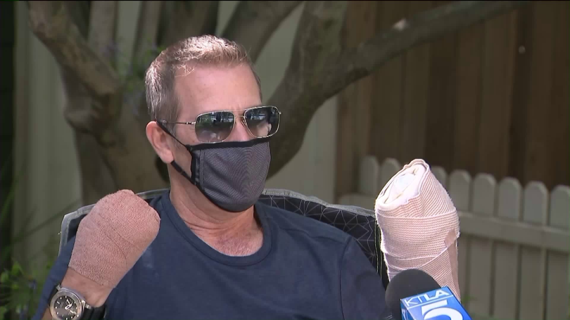 COVID-19 survivor loses fingers after servere complications
