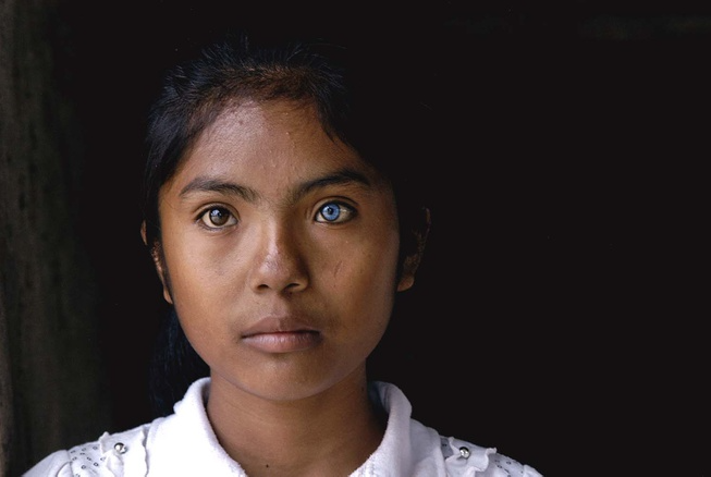 Vietnamese Girl with Different-Colored Eyes Stuns the World