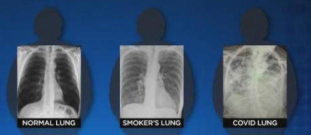Lungs damage from Covid-19 disease worse than the worst smokers's lungs