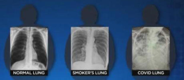 0049 normal smokers covid chest x rays