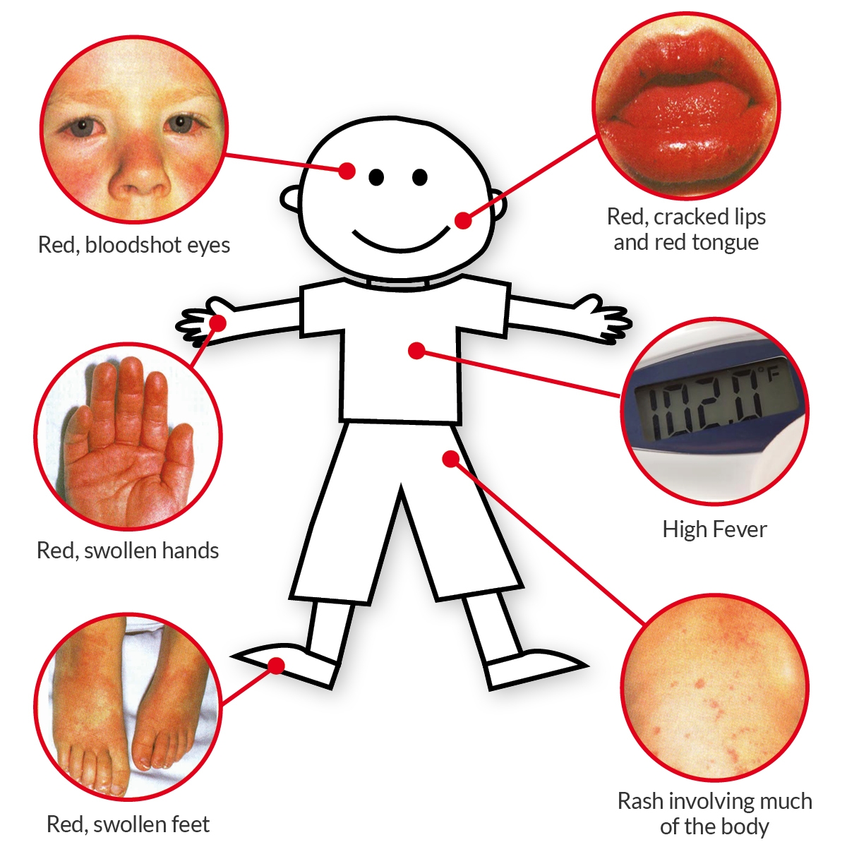 kawasaki disease what to know about emerging complication during covid 19 pandemic