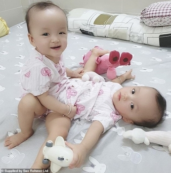 international press highlights operation to separate conjoined twins in vietnam