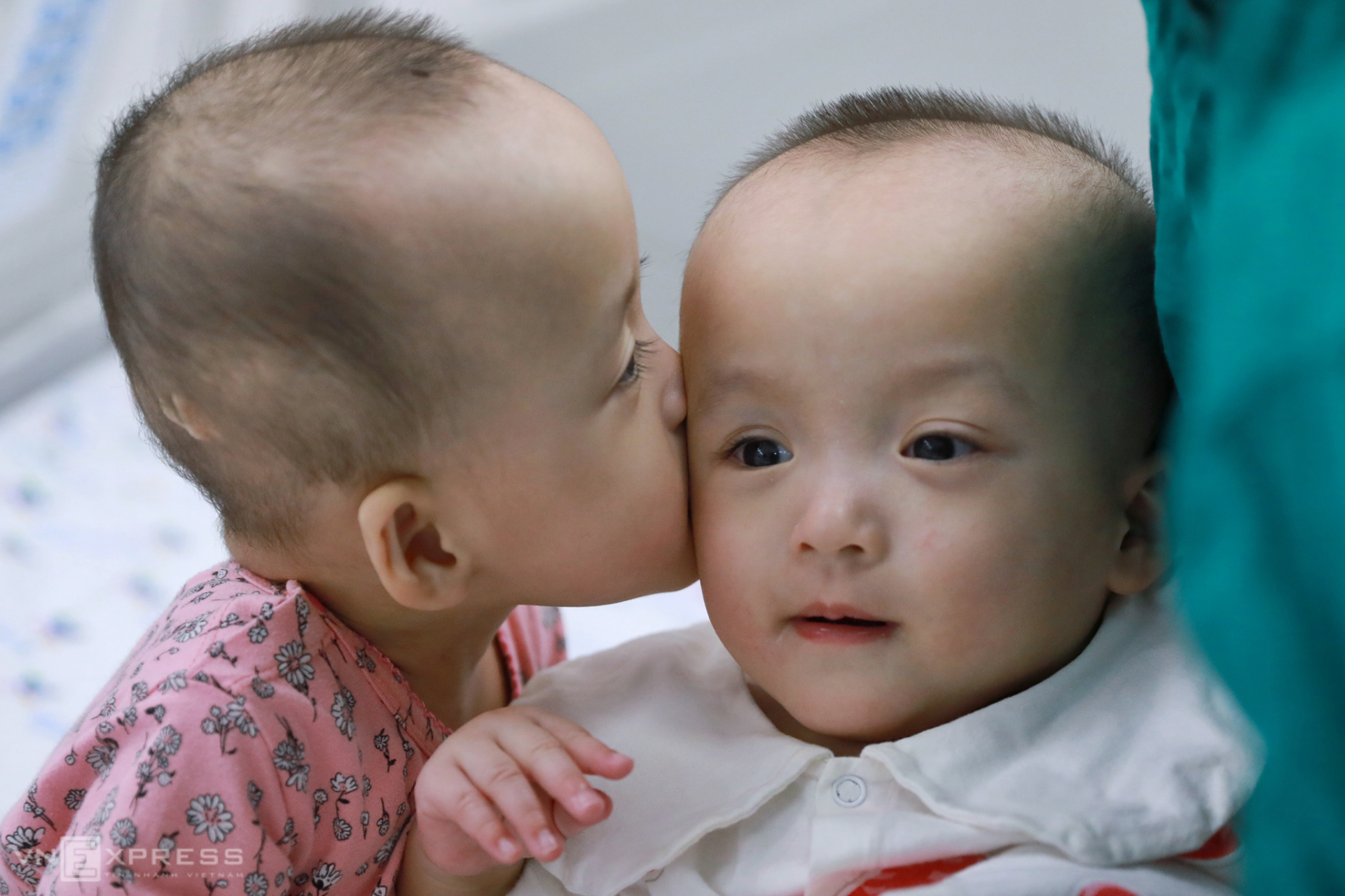 vietnamese conjoined twins learn to stand after successful surgery