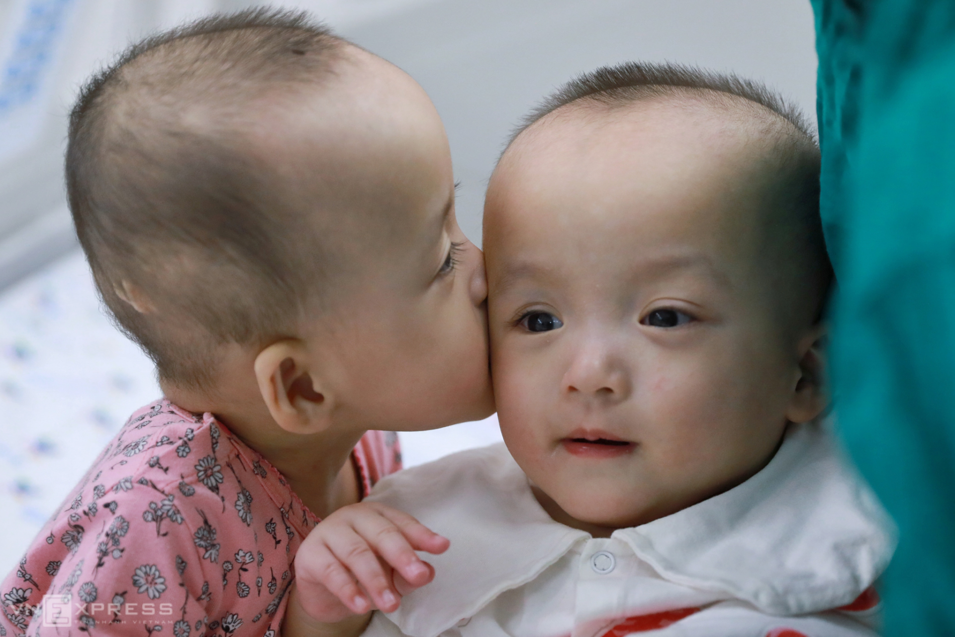 Vietnamese conjoined twins learn to stand after successful surgery