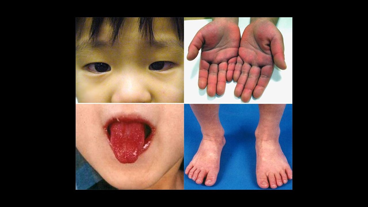 10 facts to know about kawasaki disease causes symptoms treatment link to coronavirus