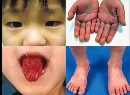 Kawasaki Disease: Causes, symptoms,  diagnosis & treatment, link to coronavirus?