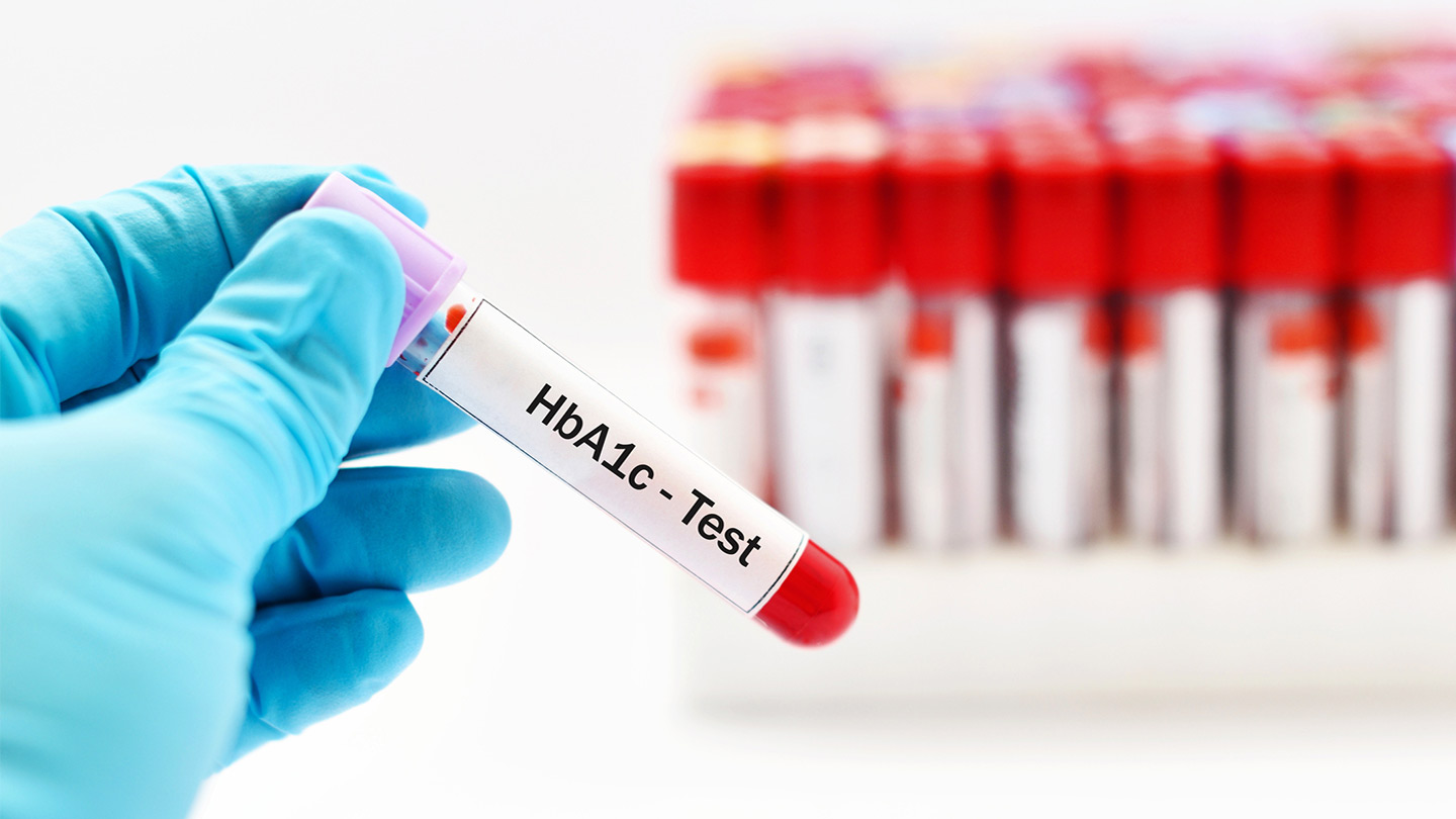 Sickle cell trait skews common diabetes test