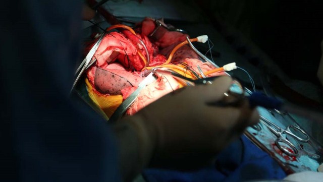 military hospital successfully performs first lung transplant in vietnam