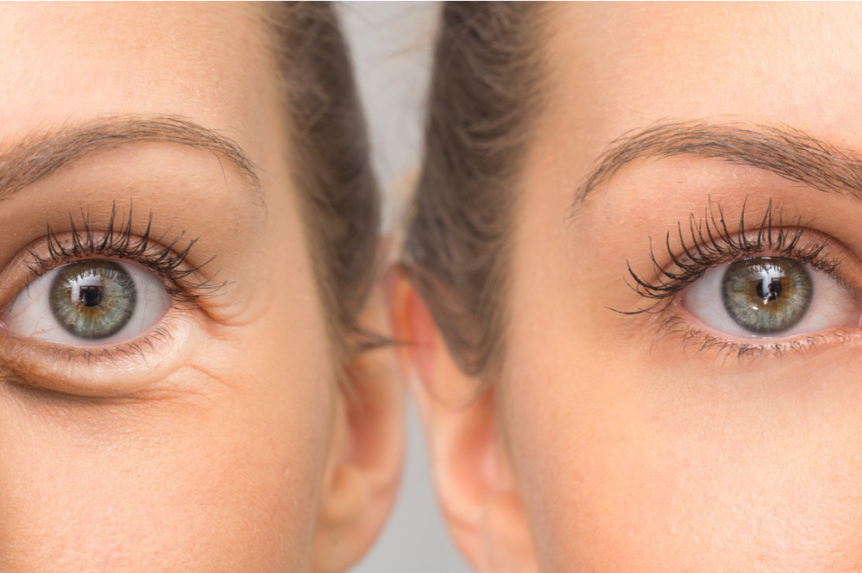 8 Natural Ways To Treat Dark Circles And Under-Eye Puffiness - SUGAR  Cosmetics