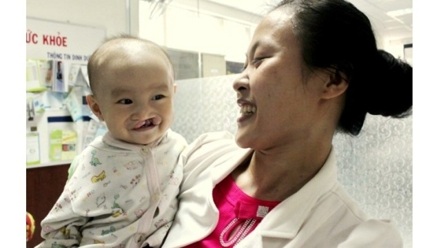 nearly 300 children with cleft lips and palates to receive free operations in october