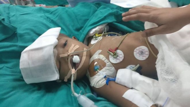 India: Separated twin 'opens eyes' four days after surgery
